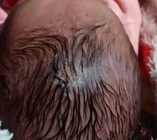 Caso chocante: Bebê tem parte da cabeça cortada durante parto em SC