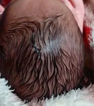 Caso chocante: Bebê tem parte da cabeça cortada durante parto em SC