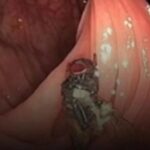 Homem de 63 anos encontra mosca viva no intestino durante exame de rotina