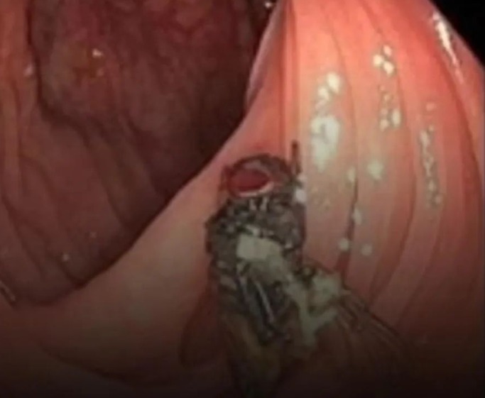 Homem de 63 anos encontra mosca viva no intestino durante exame de rotina