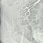 Secretaria de Saúde de João Pinheiro confirma retirada