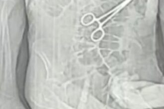 Secretaria de Saúde de João Pinheiro confirma retirada