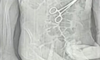 Secretaria de Saúde de João Pinheiro confirma retirada