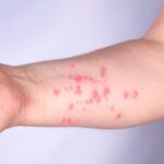 Brasil registra 88 casos de Mpox em 2026; saiba como evitar a doença