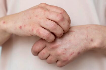 Ministério da Saúde emite alerta máximo após avanço da Mpox no Brasil