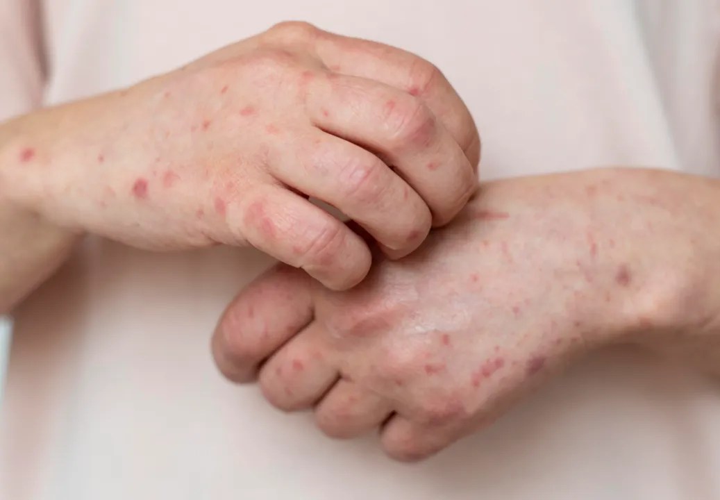 Ministério da Saúde emite alerta máximo após avanço da Mpox no Brasil